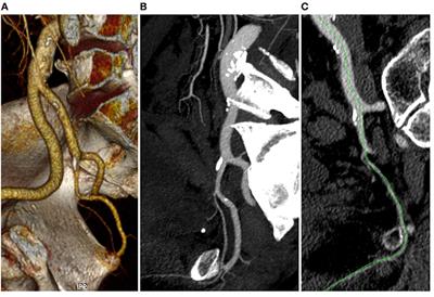 Prevalence of Erectile Dysfunction in Patients With Abdominal Aortic Aneurysm: An Exploratory Study